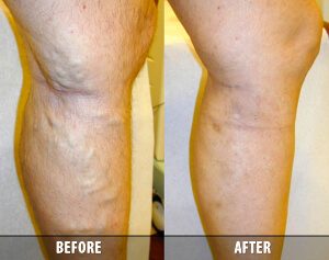 What Is Endovenous Laser Therapy In Schaumburg IL And How Does It Work?